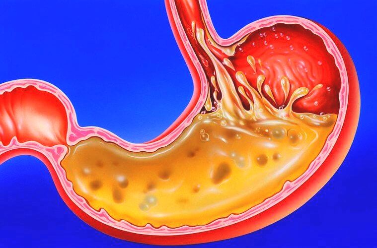 15 Conseils Pour Lutter Contre Les Brûlures D'estomac + 10 Causes