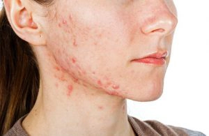 acné vulgaris