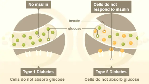 diabète de type 2 et type 1
